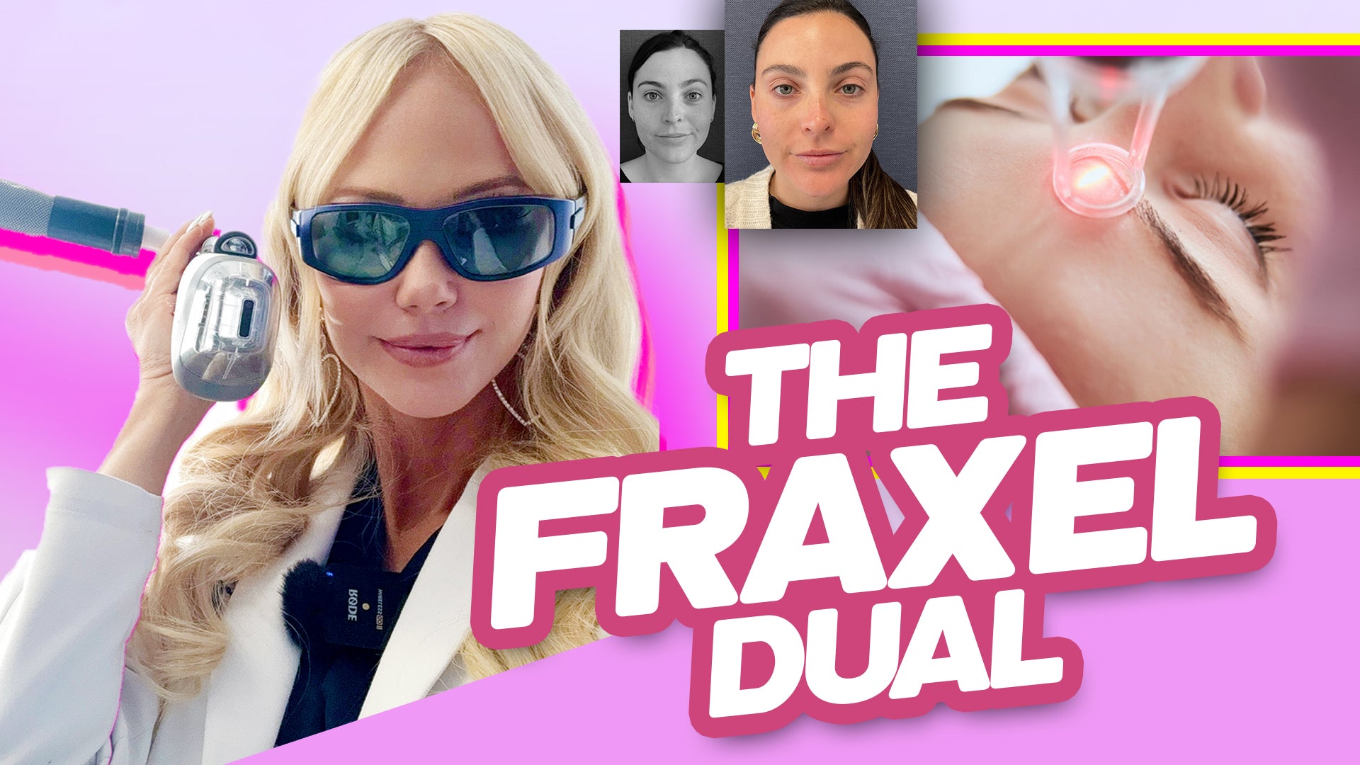 Fraxel Dual Laser: Why It's My Favorite Treatment – MDAiRE™